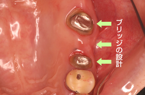 臼歯ブリッジ