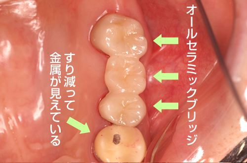 臼歯ブリッジ