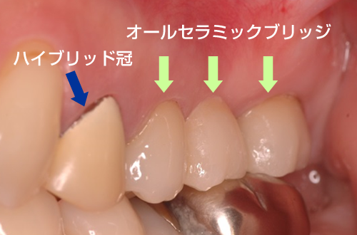 臼歯ブリッジ