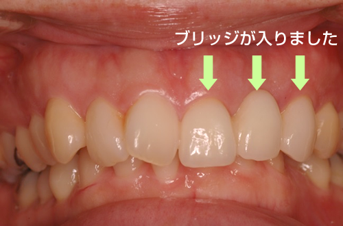 前歯ブリッジ